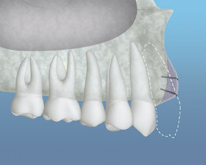A depiction of the placed bone grafting material to increase the bone structure