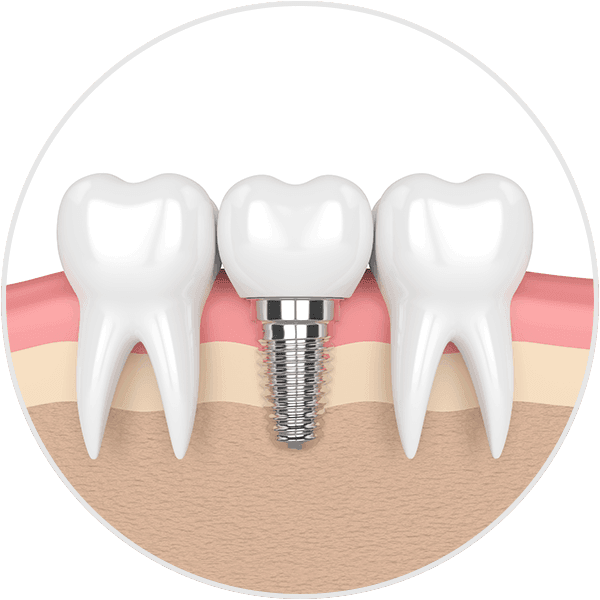 Dental Implant Illustration
