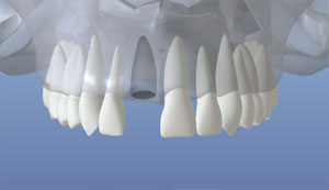 An example of the upper jaw missing a tooth with the jaw bone unhealed
