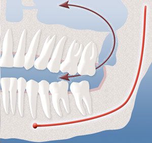 A diagram showing the opening that can occur between your mouth and sinuses